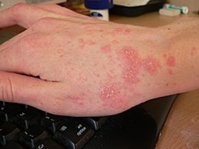 Scabies on the hand and wrist after one week of treatment.